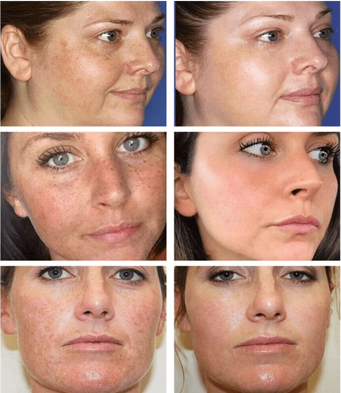 Whitening Freckle Cream Dark Spots Face Moisturizing Dr.Hancy Skin Care