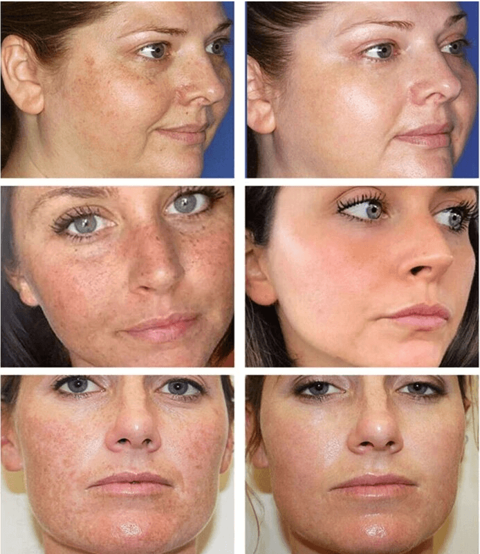 Whitening Freckle Cream  Dark Spots Face Moisturizing Dr.Hancy  Skin Care