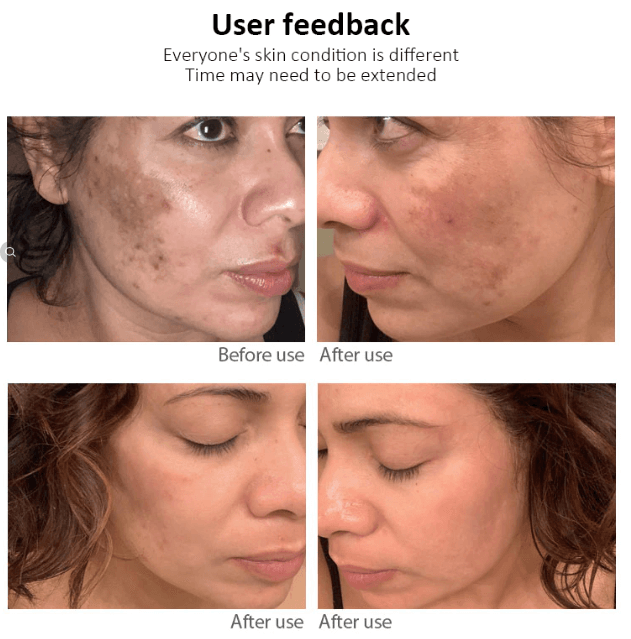 Whitening Freckle Cream  Dark Spots Face Moisturizing Dr.Hancy  Skin Care
