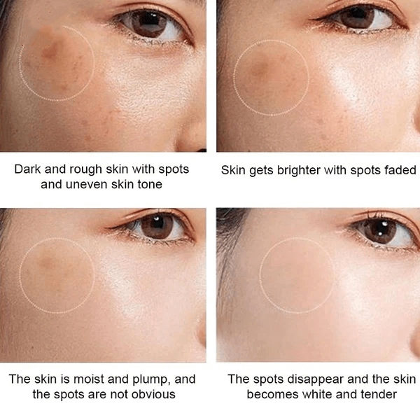 Whitening Freckle Cream  Dark Spots Face Moisturizing Dr.Hancy  Skin Care