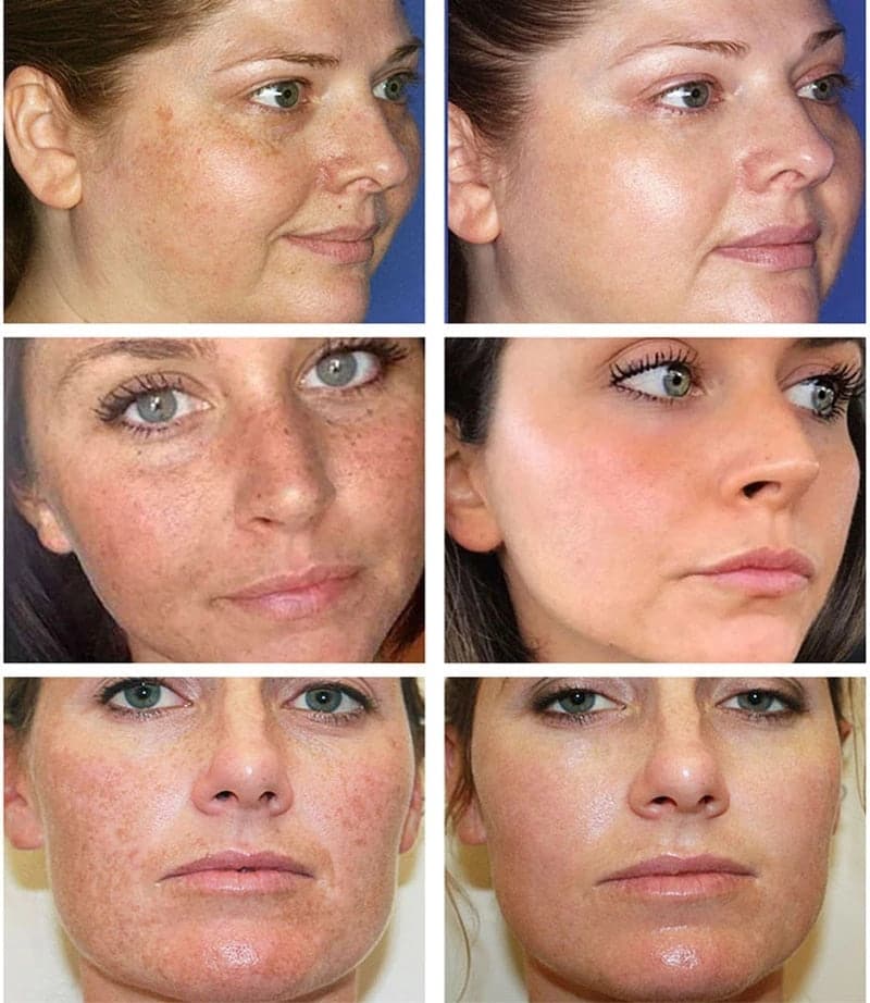 Skin Lightening Whitening Melasma Cream