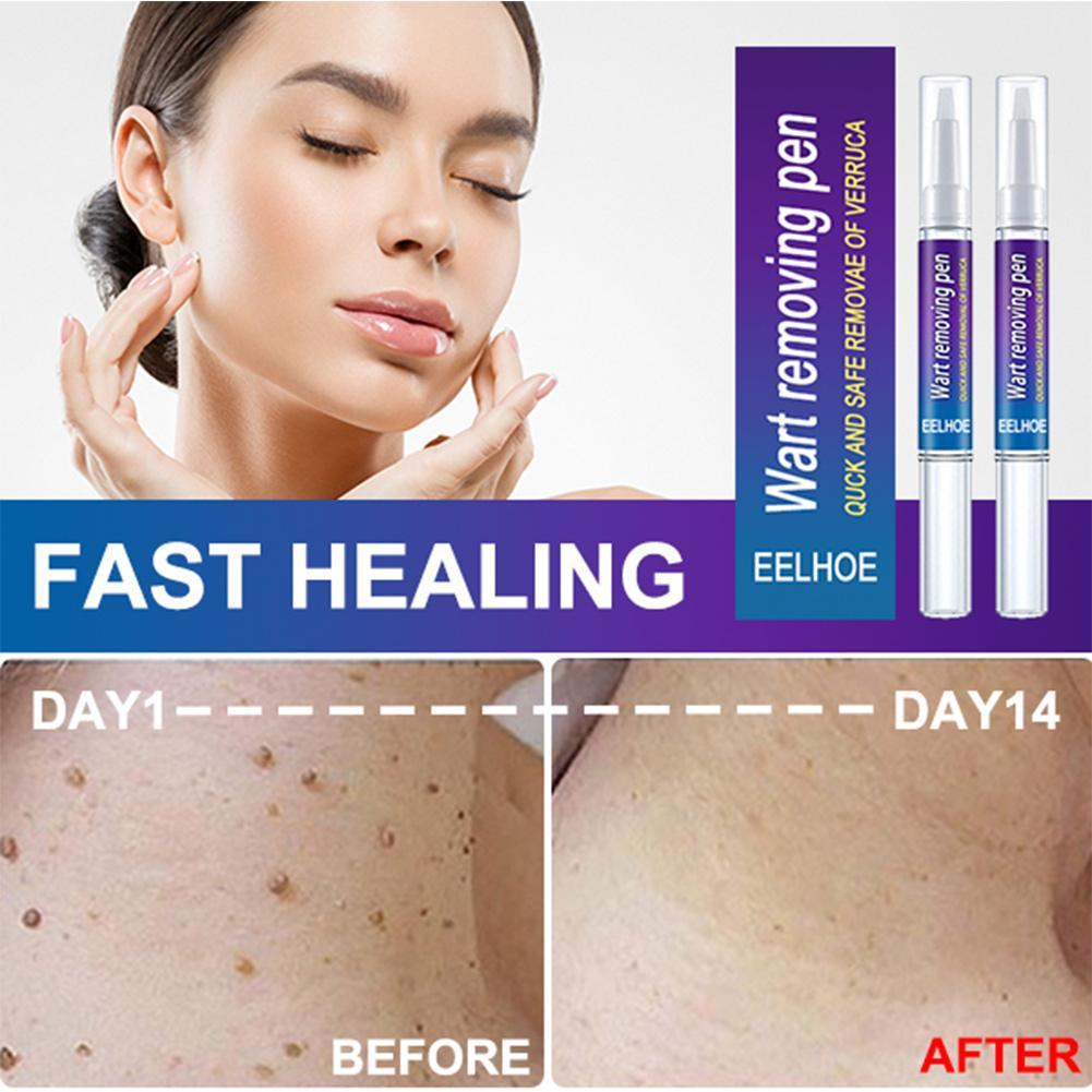 Wart Removing Against Moles Liquid Pen