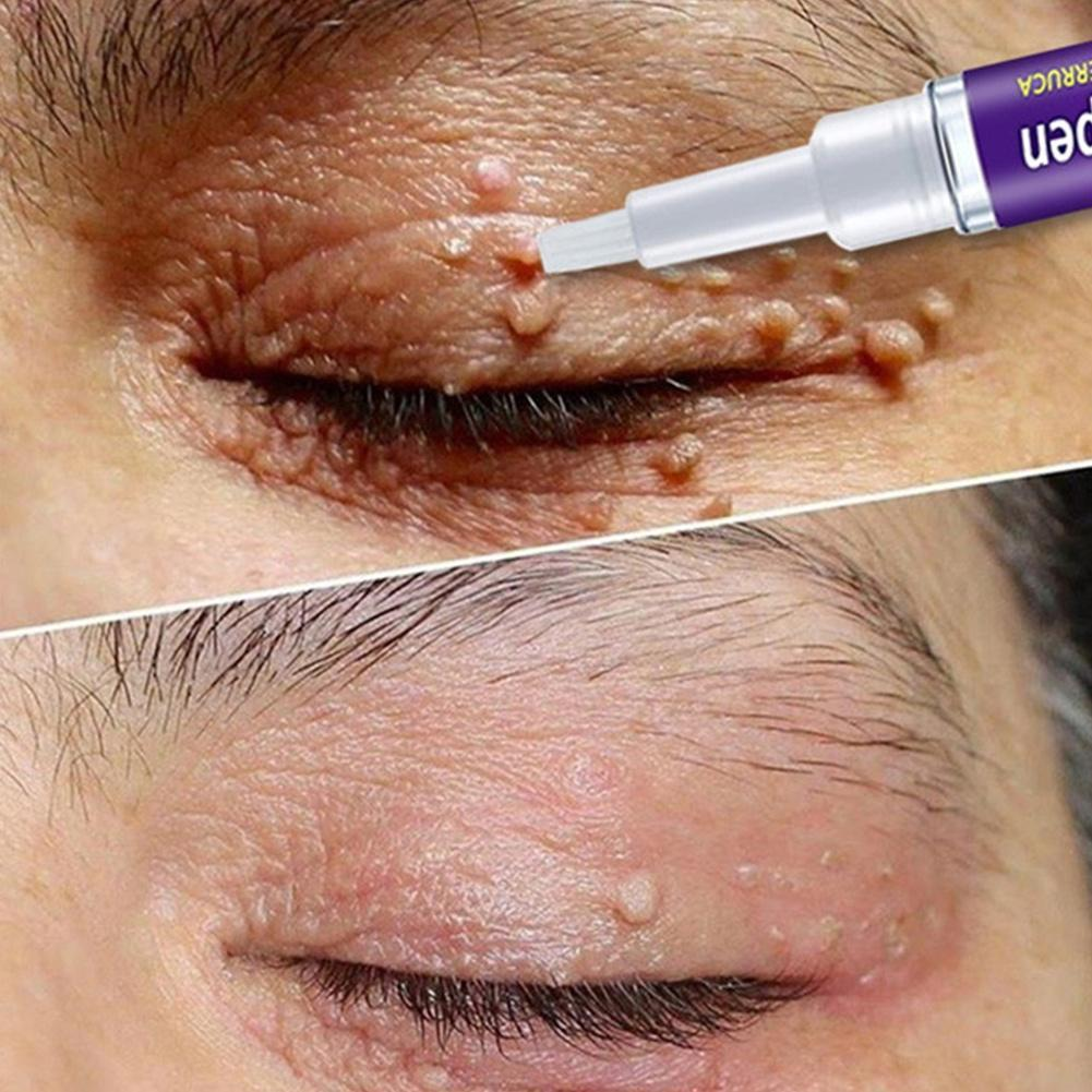 Wart Removing Against Moles Liquid Pen