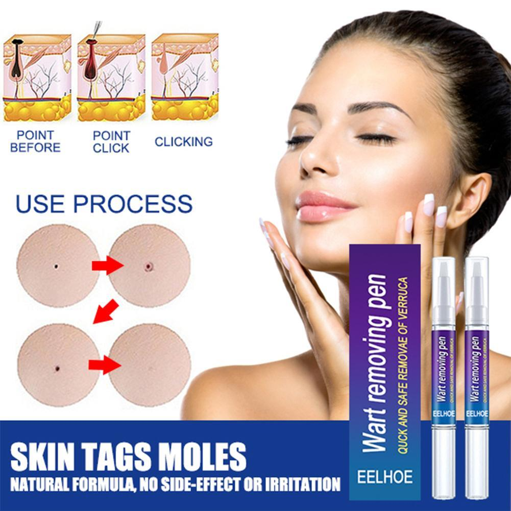 Wart Removing Against Moles Liquid Pen