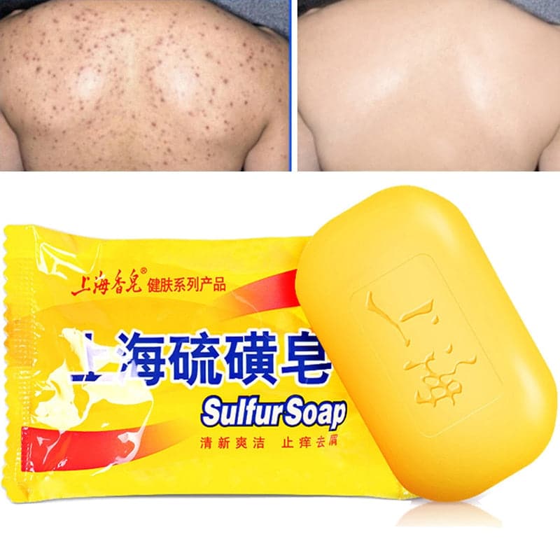 85g Soap Seborrhea Eczema Anti Fungus Bath Healthy Soaps