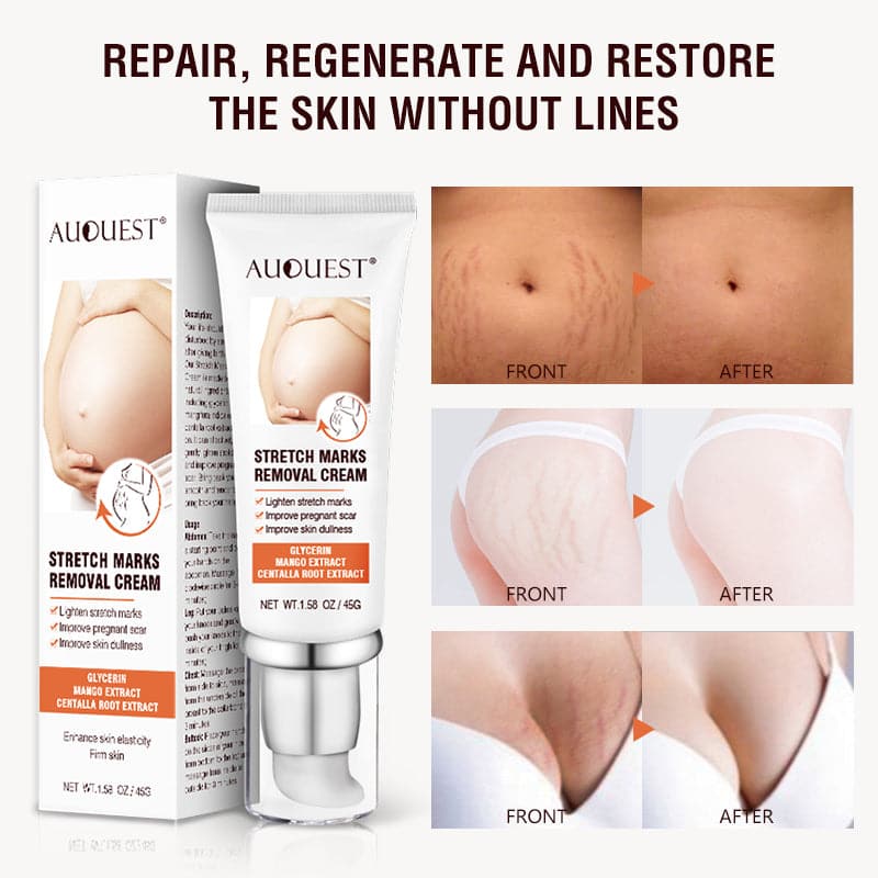 TikTok Maternity Stretch Marks Removal Cream   Scar Remover Cream